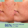 Acne Prone Skin Essentials